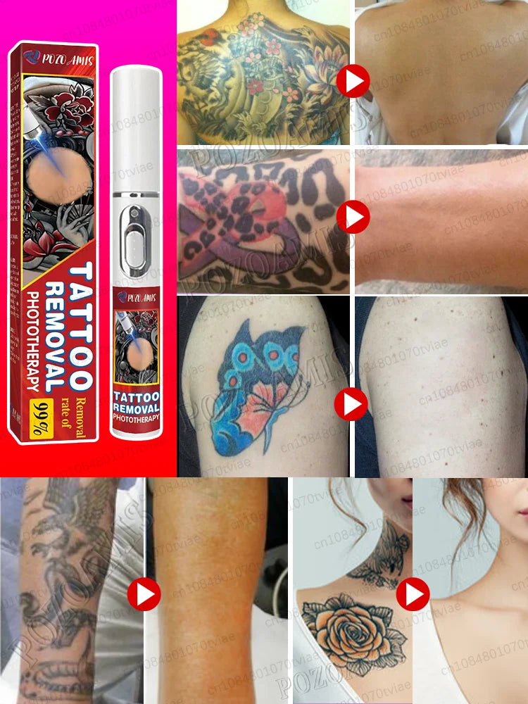 ᵖᵃⁱⁿˡᵉˢˢ ʳᵉᵐᵒᵛᵃˡ‧Nano laser removes all tattoos, painless removal.